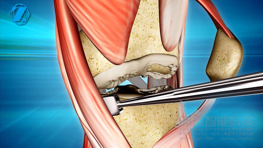 膝关节置换术医疗演示动画视频