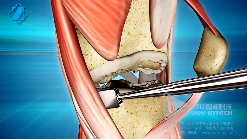 膝关节置换术三维动画制作